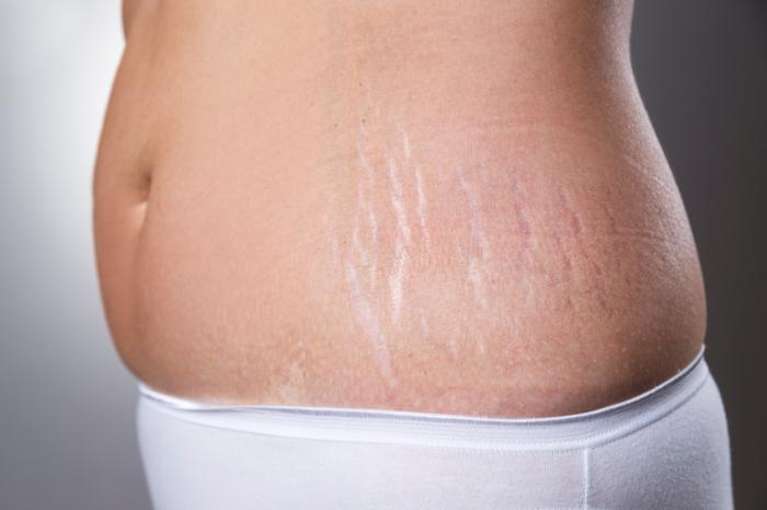 Stretch Mark merupakan Salah Satu Masalah Kulit yang Membuat Cewek Tidak Percaya Diri